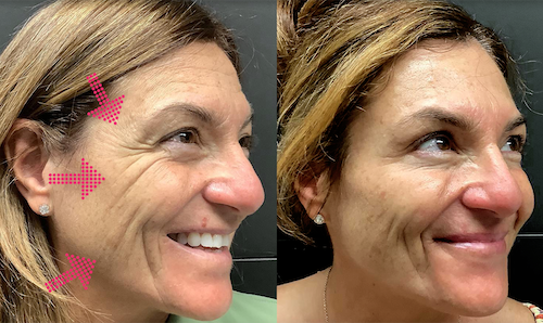 Crows Feet Reduction Before After Mississauga Neurotoxin